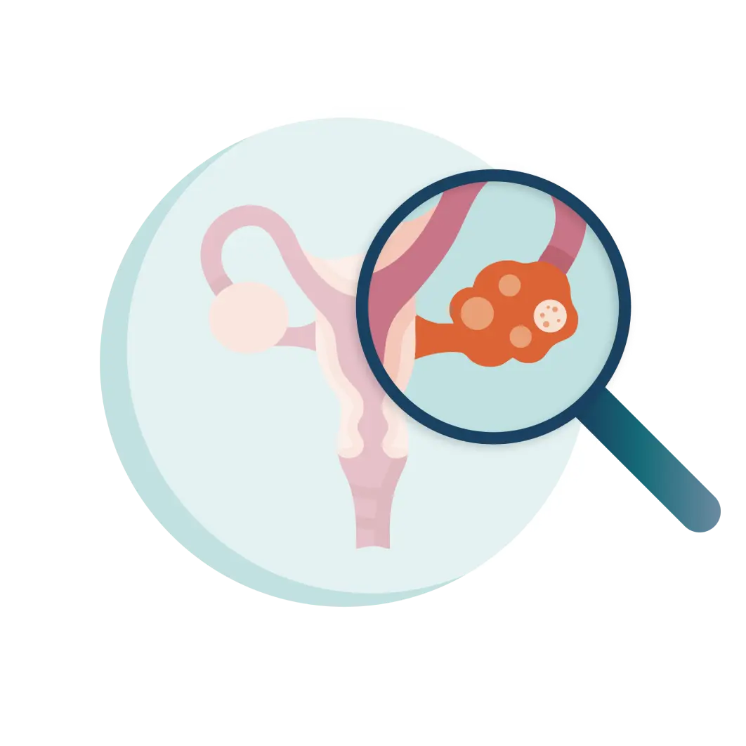 An illustration graphic of the female reproductive system with a magnifying glass zooming in on the ovaries